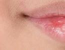 Cracked lips: causes and treatment How to cure a cracked lip
