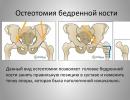 Types of corrective osteotomy, rehabilitation after surgery