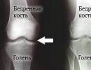 Osteotoomia tüübid: Sall, chevron, Salter, Akin ja teised
